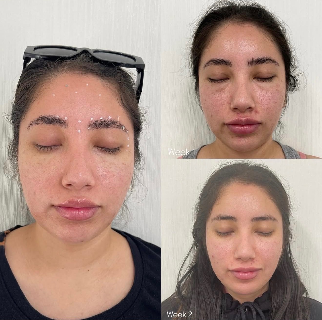 Botox Treatment Progression